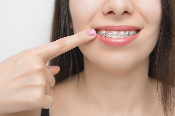 Why Clear Braces Are A Popular Option For Teeth Straightening