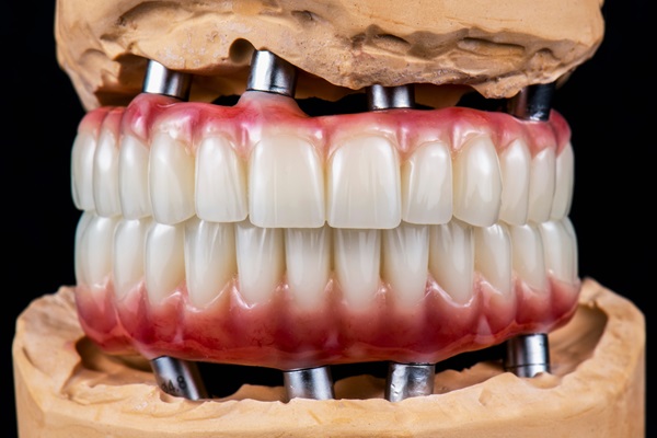 Implant Supported Dentures: Reasons To Consider All On